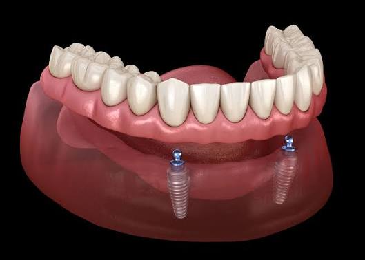 Snap-In Dentures in Encino