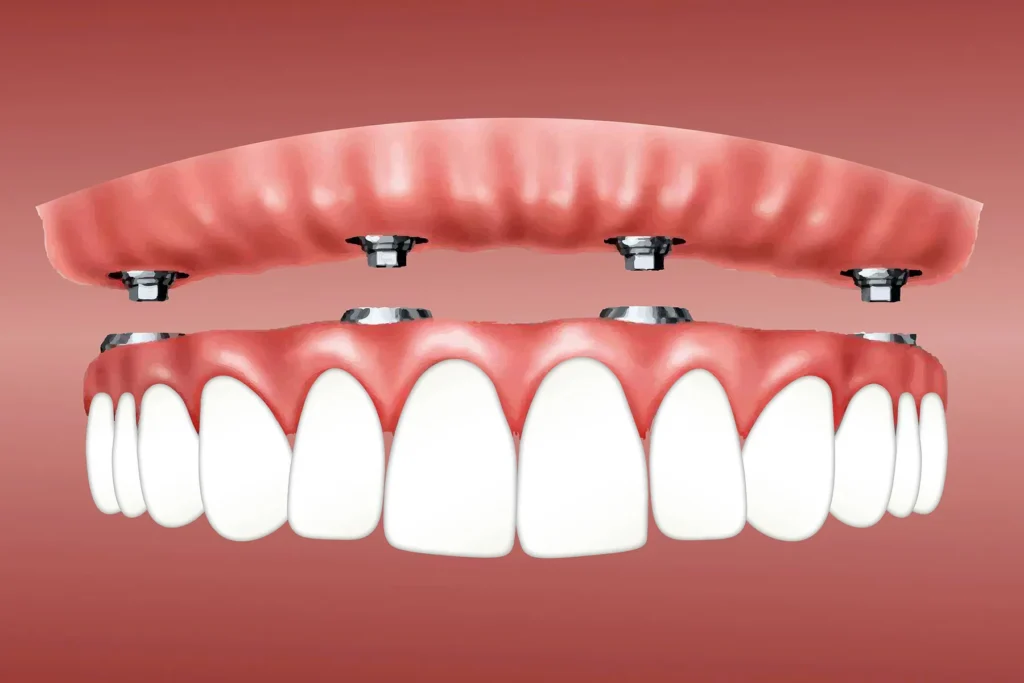 Snap-In Dentures in Encino