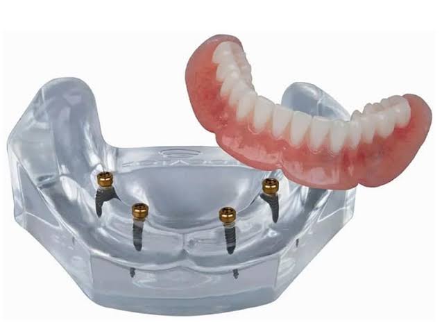 Snap-In Dentures in Encino